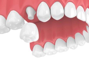 Dental crowns in Toronto