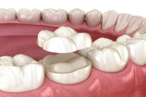 Dental Crowns vs. Fillings: Which One Do You Need?